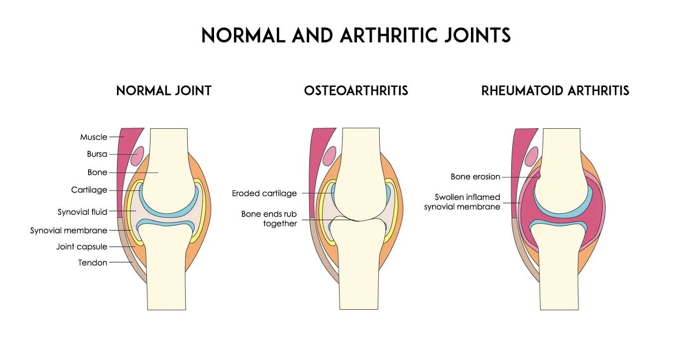 causes Arthritis