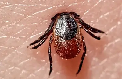 What is Lyme Disease - Early signs and symptoms