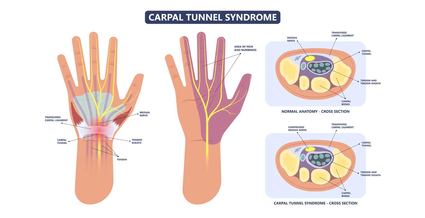 Carpal tunnel syndrome treated